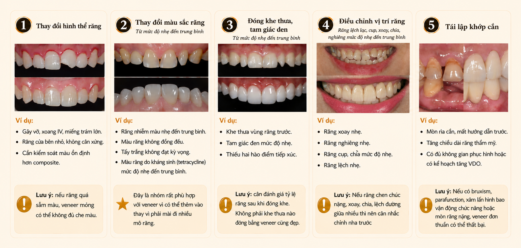5 nhóm chỉ định phù hợp với veneer
