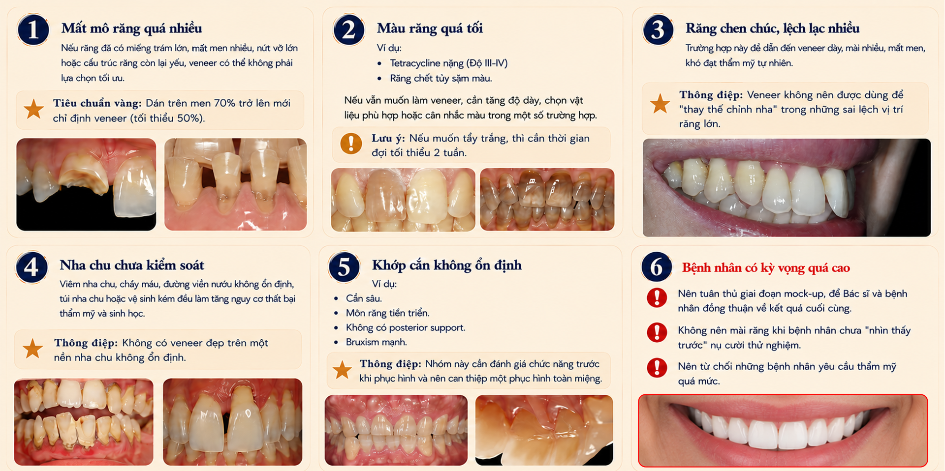 6 tình huống không nên vội làm veneer