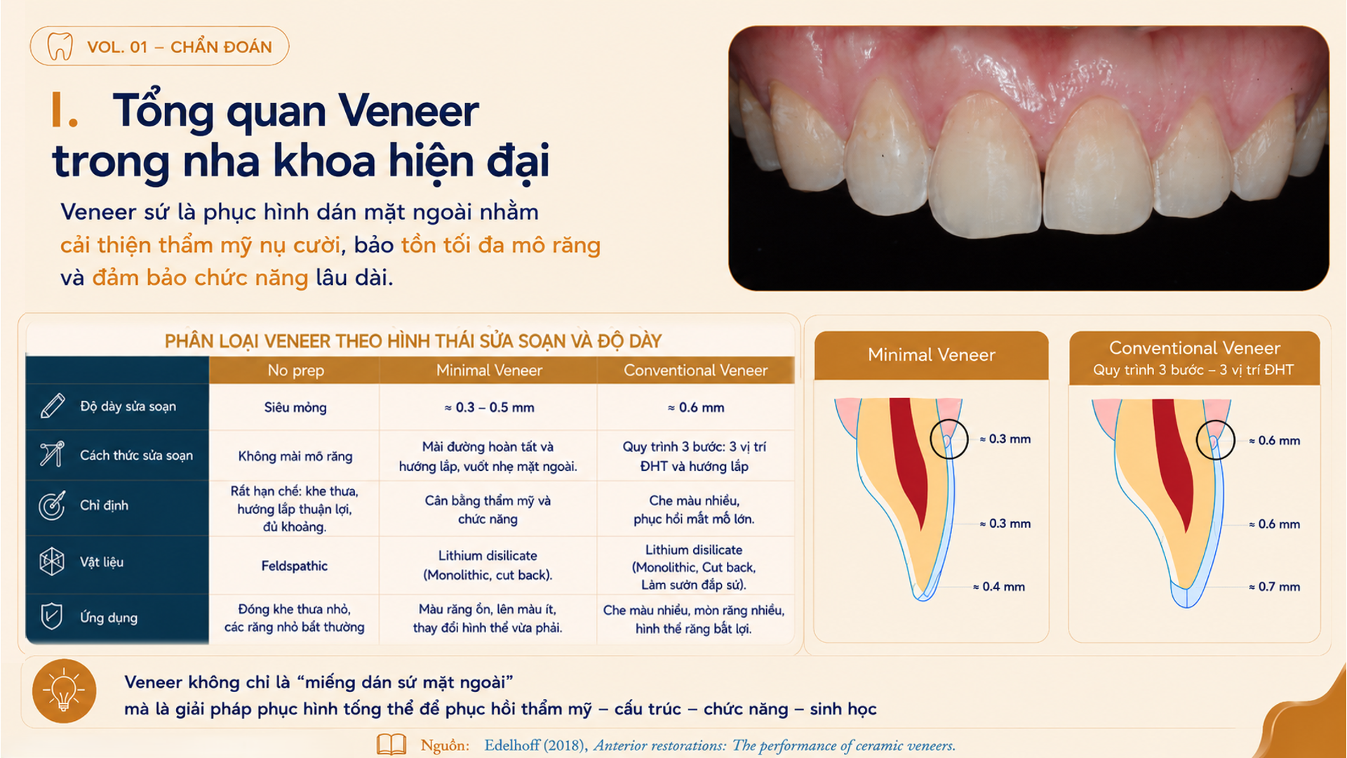 Tổng quan Veneer trong nha khoa hiện đại