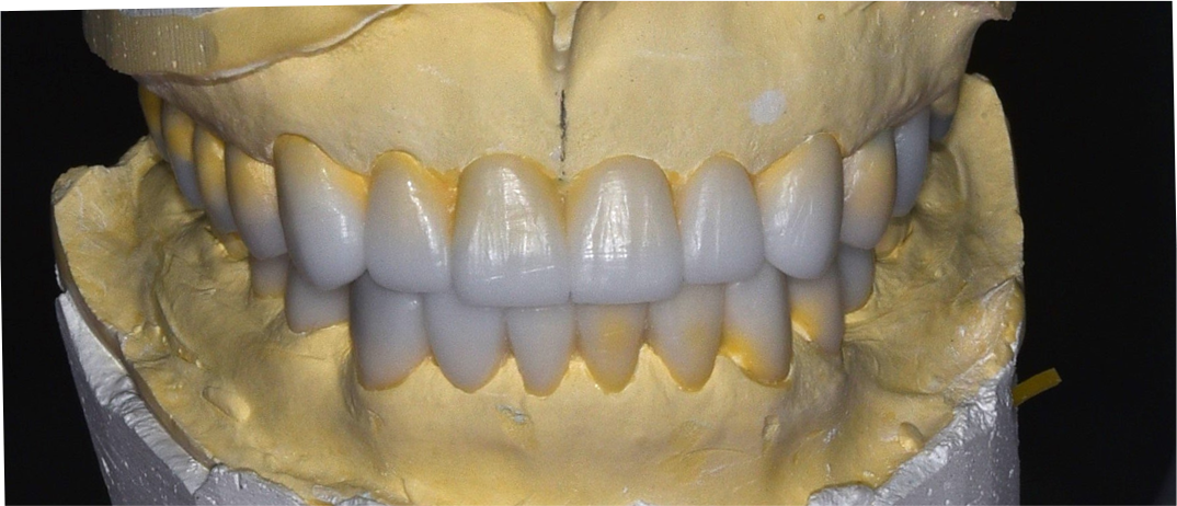 Wax-up