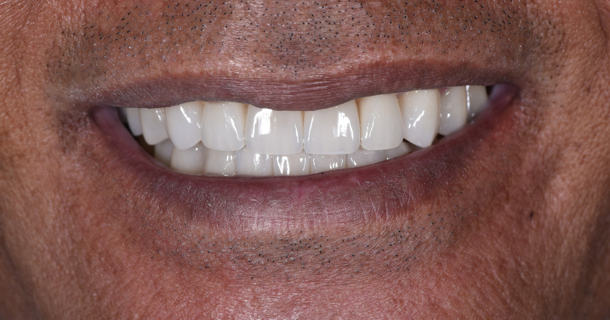 Final Veneer