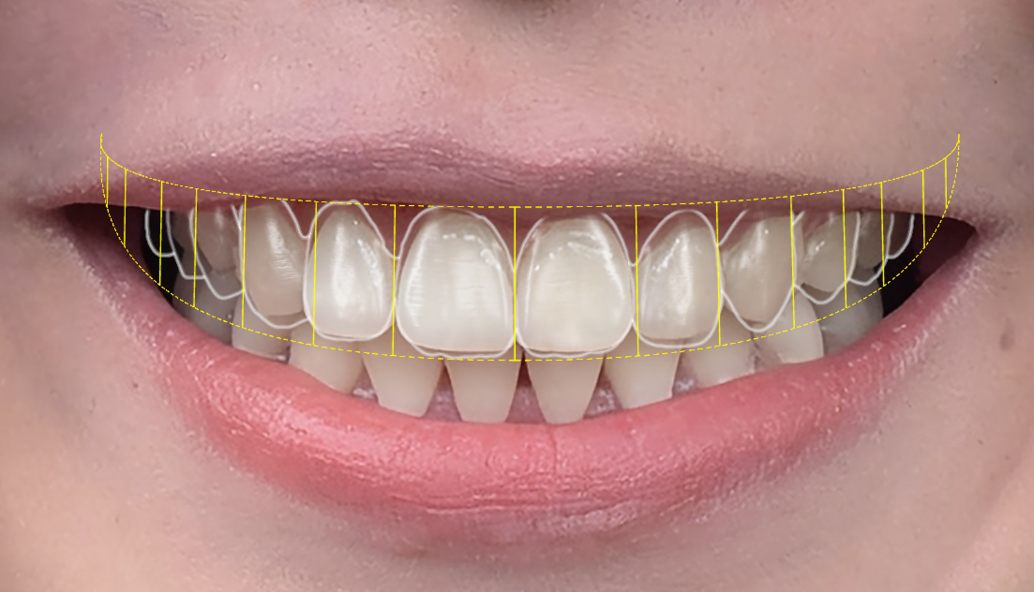 Nụ cười thẩm mỹ Veneer