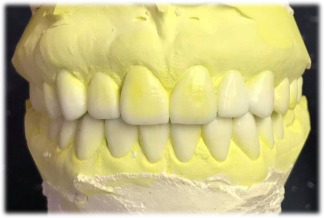 Wax-up