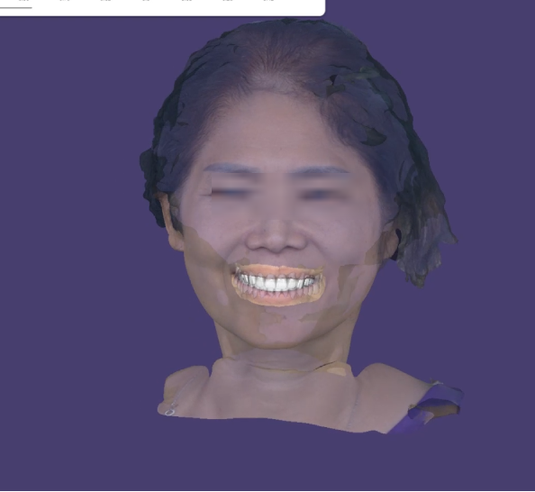 Digital Wax-up