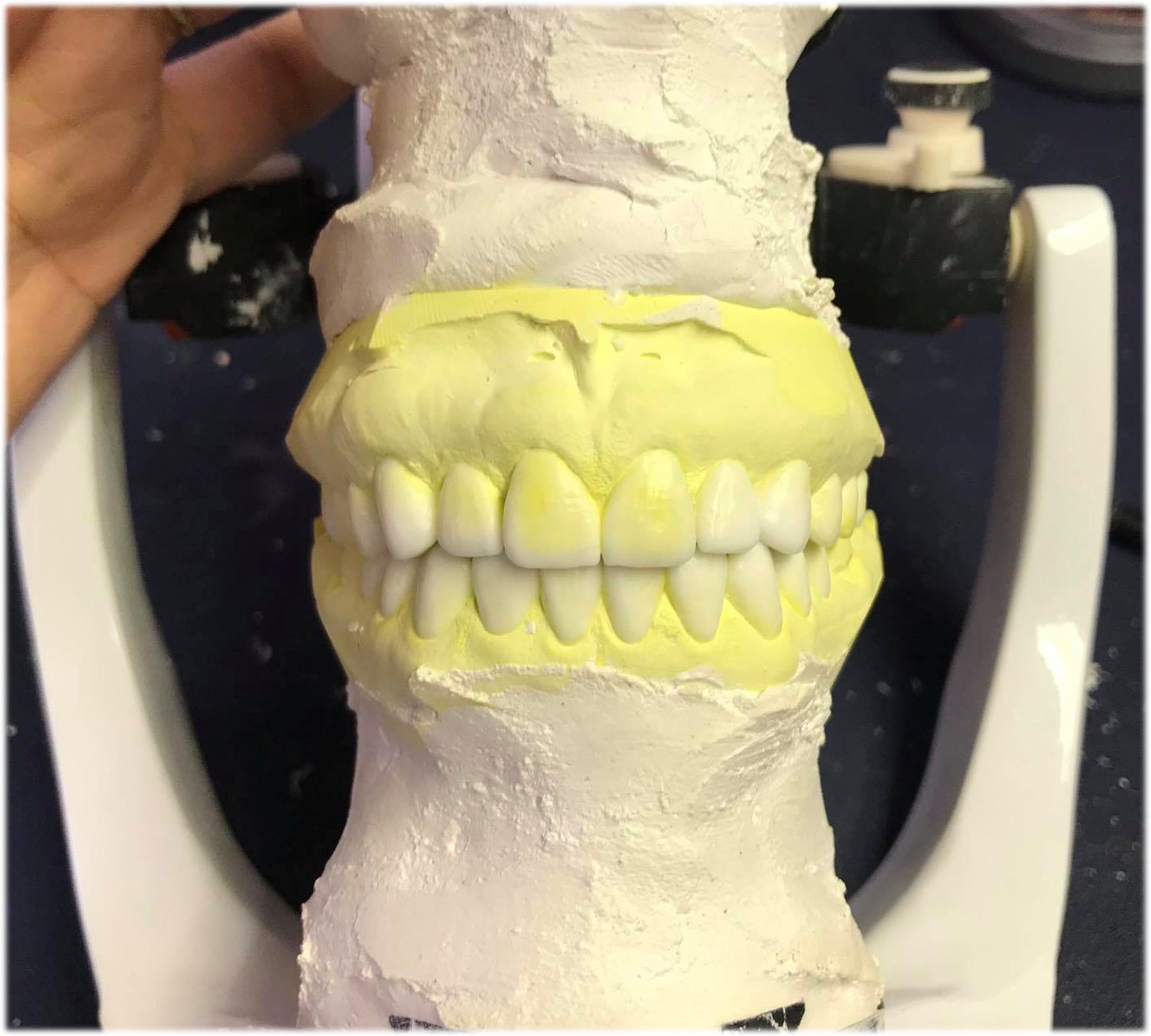 Traditional Wax-up